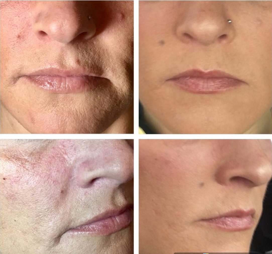 before and after, face fabulous medical spa, clarksville, tn
