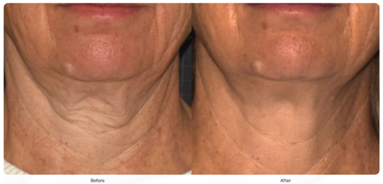 Softwave treatment - before and after - Face Fabulous