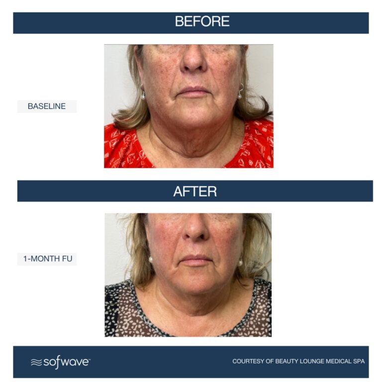 Set-100-Full-Face-Neck