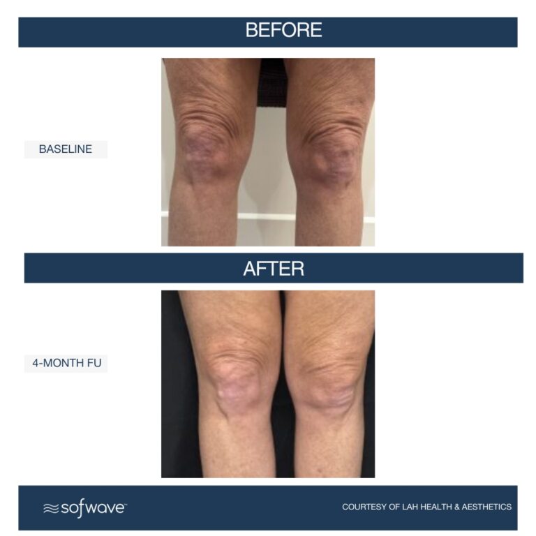 Set-107-Above-The-Knees