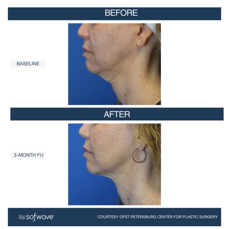 Set-108-Full-Face-Neck