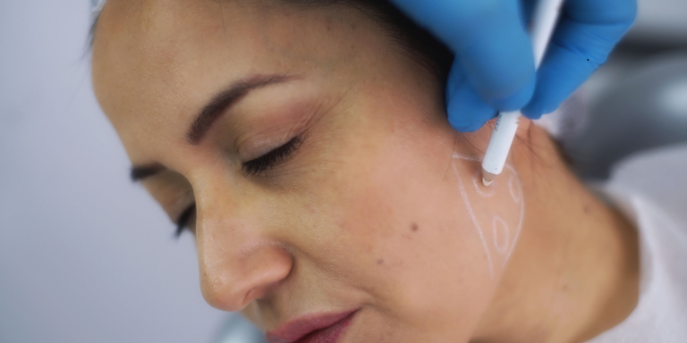 How Sculptra compares to traditional dermal fillers for jawline contouring