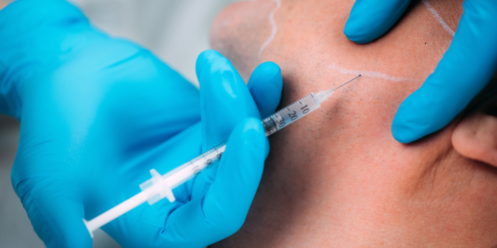 How long Sculptra jawline results last and what maintenance looks like
